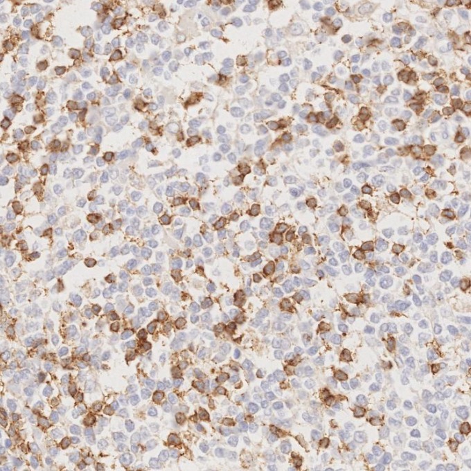 IHC staining of human lymphoma using 66220-1-Ig IHC staining of human lymphoma using 66220-1-Ig