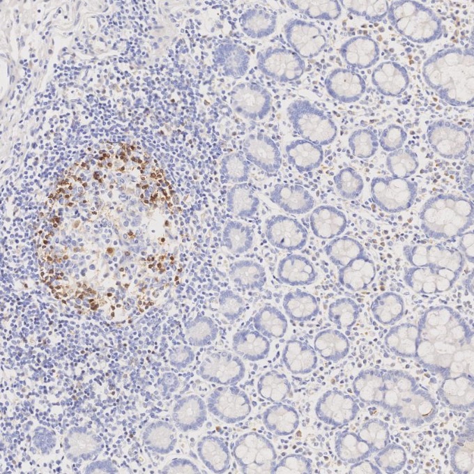 IHC staining of human lymphoma using 66220-1-Ig IHC staining of human lymphoma using 66220-1-Ig