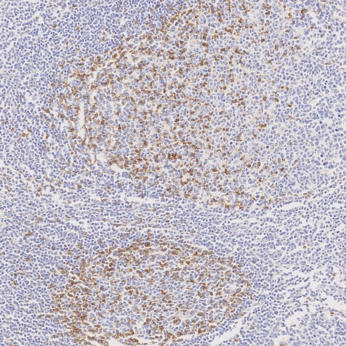 IHC staining of human tonsillitis using 66220-1-Ig IHC staining of human tonsillitis using 66220-1-Ig