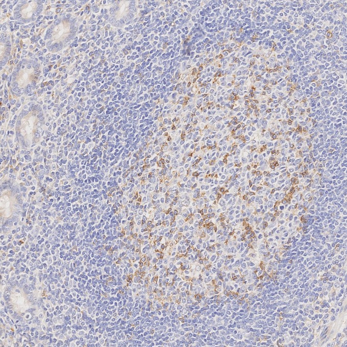 IHC staining of human appendicitis using 66220-1-Ig IHC staining of human appendicitis using 66220-1-Ig
