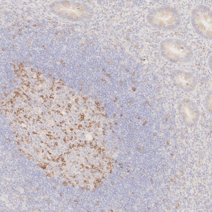 IHC staining of human appendicitis using 66220-1-Ig IHC staining of human appendicitis using 66220-1-Ig