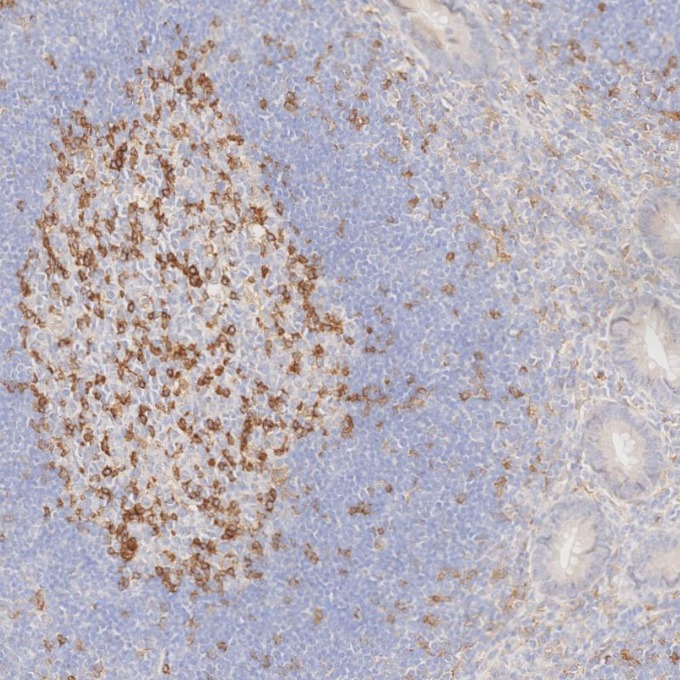 IHC staining of human appendicitis using 66220-1-Ig IHC staining of human appendicitis using 66220-1-Ig