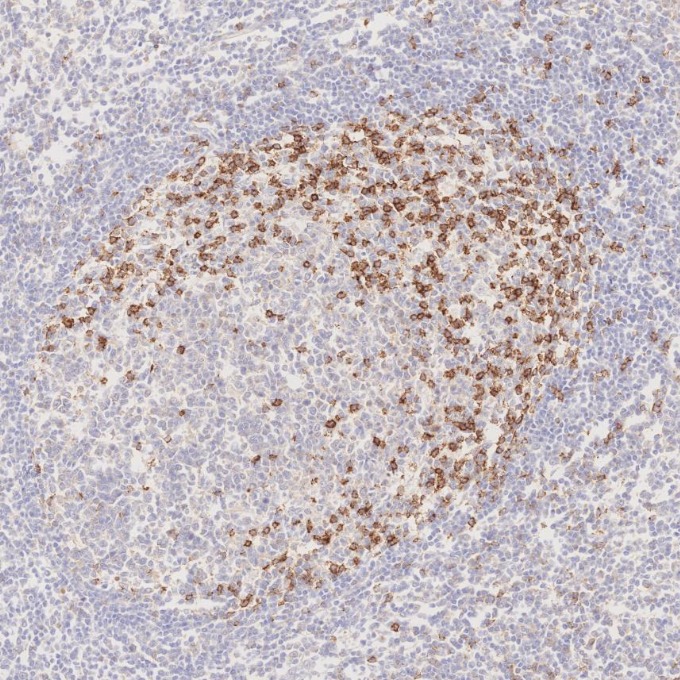 IHC staining of human tonsillitis using 66220-1-Ig IHC staining of human tonsillitis using 66220-1-Ig