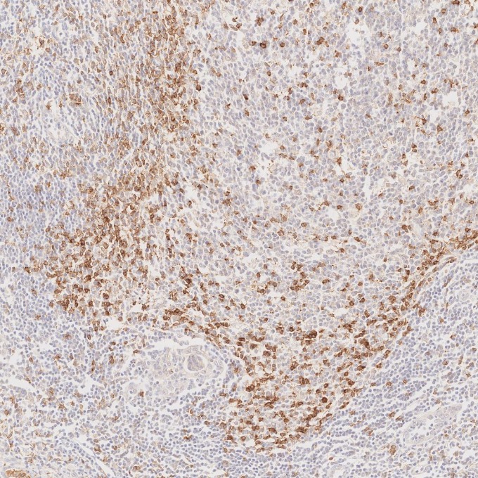 IHC staining of human lymphoma using 66220-1-Ig IHC staining of human lymphoma using 66220-1-Ig