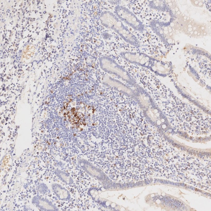 IHC staining of human lymphoma using 66220-1-Ig IHC staining of human lymphoma using 66220-1-Ig