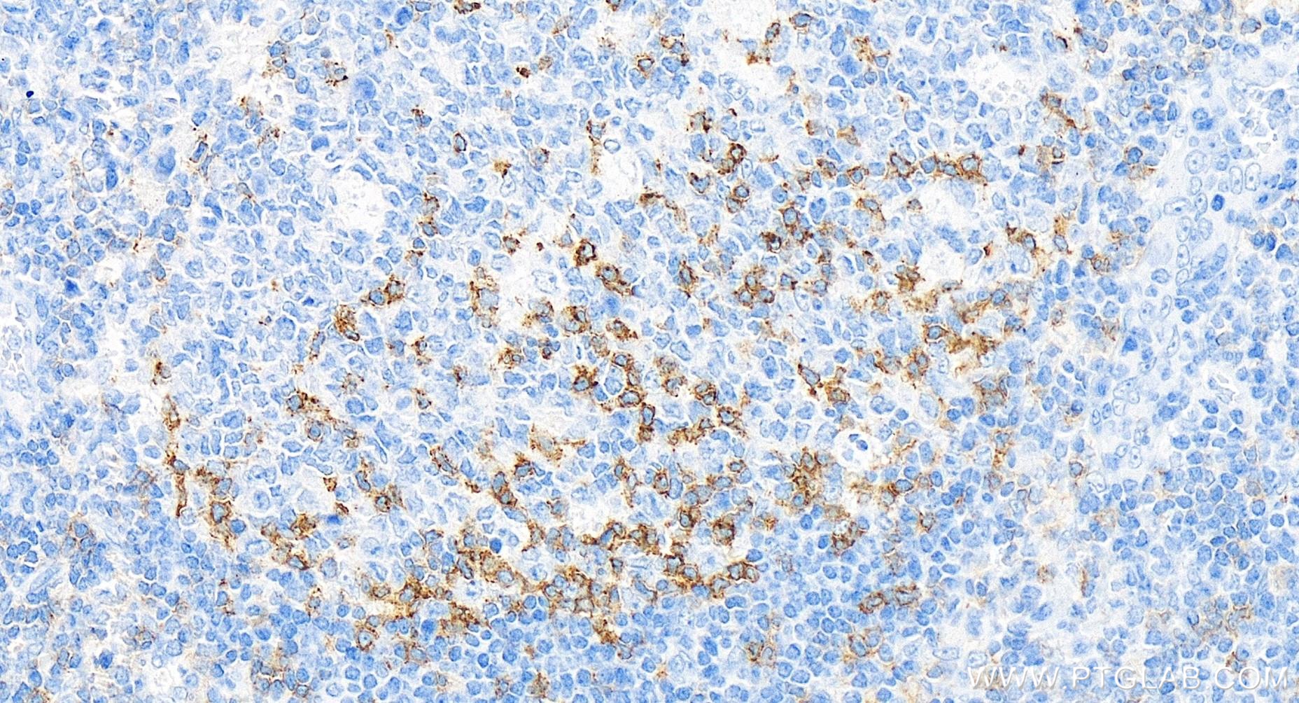 IHC staining of human tonsillitis using 98068-1-RR