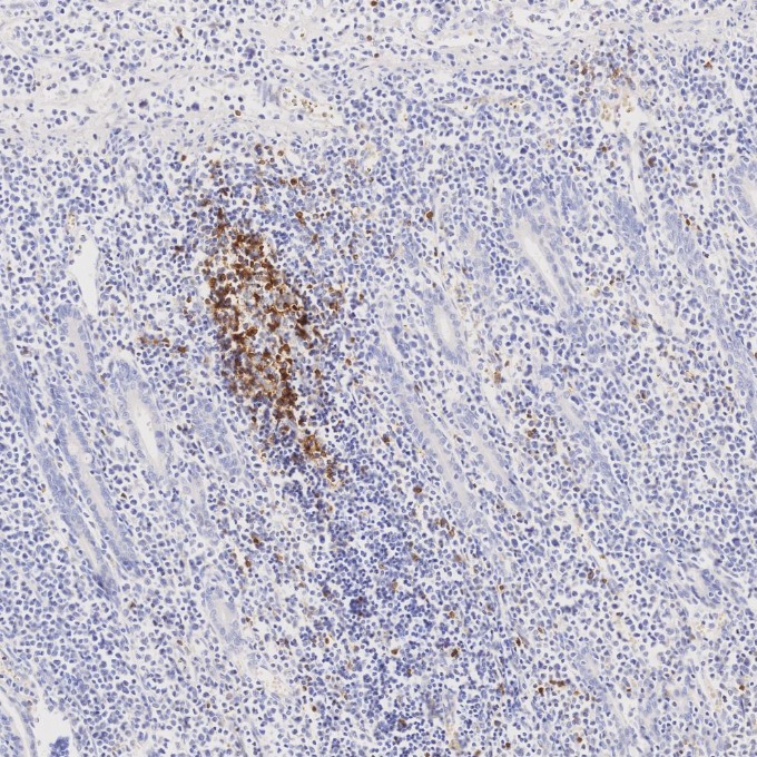 IHC staining of human lymphoma using 98068-1-RR (same clone as 98068-1-PBS) IHC staining of human lymphoma using 98068-1-RR (same clone as 98068-1-PBS)