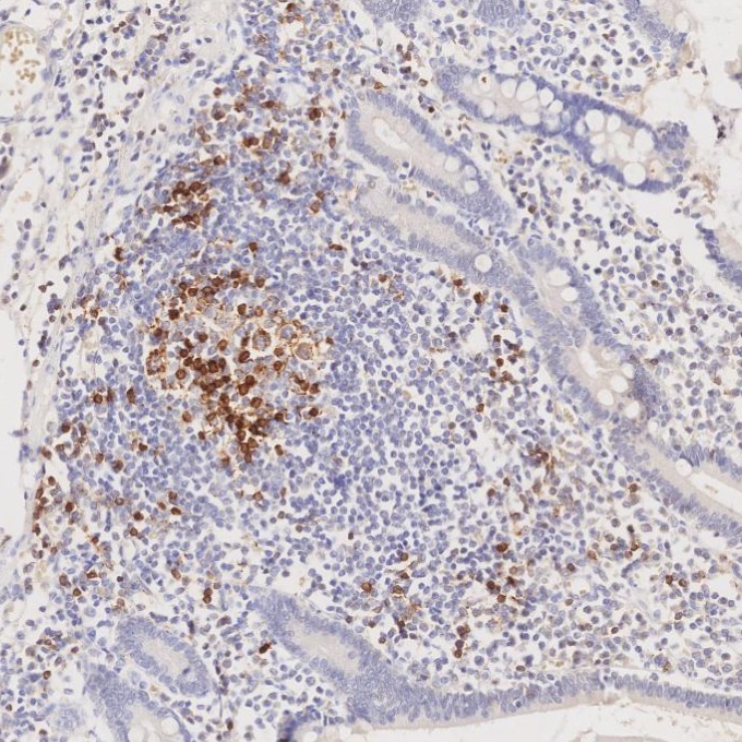 IHC staining of human lymphoma using 98068-1-RR (same clone as 98068-1-PBS) IHC staining of human lymphoma using 98068-1-RR (same clone as 98068-1-PBS)