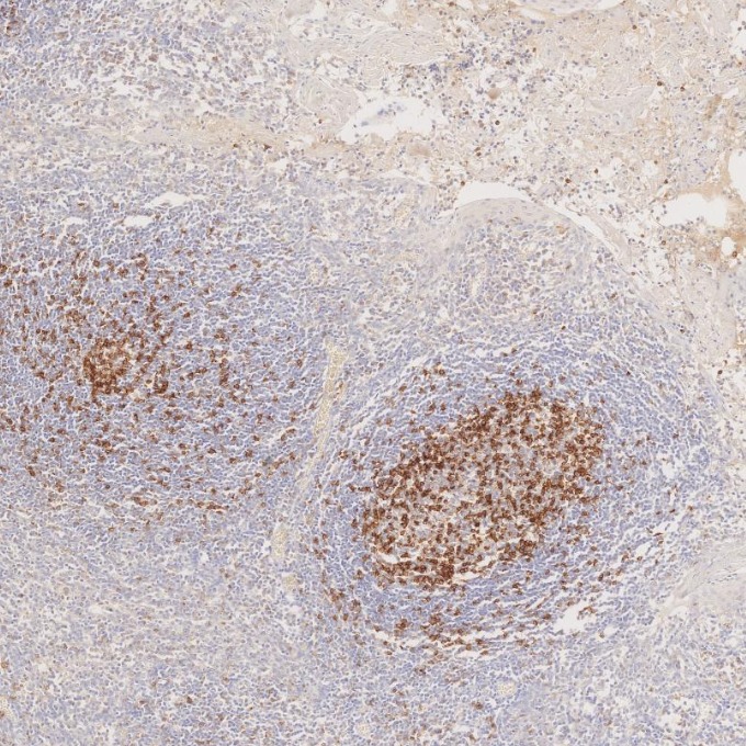 IHC staining of human tonsillitis using 98068-1-RR (same clone as 98068-1-PBS) IHC staining of human tonsillitis using 98068-1-RR (same clone as 98068-1-PBS)