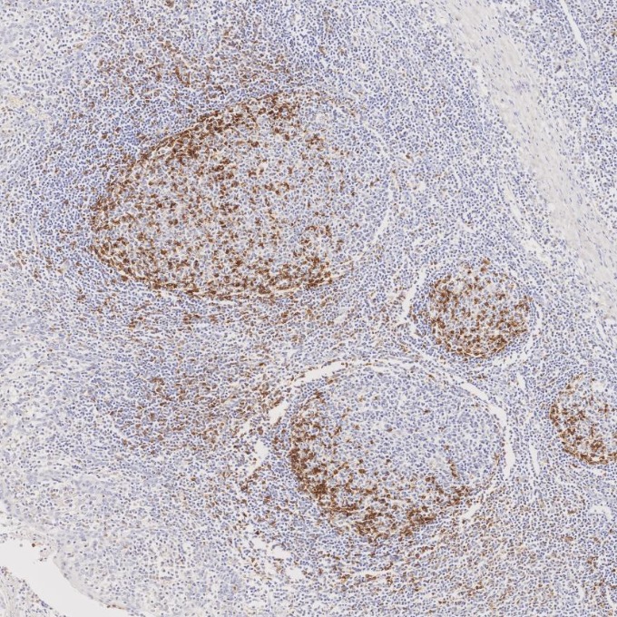 IHC staining of human tonsillitis using 98068-1-RR (same clone as 98068-1-PBS) IHC staining of human tonsillitis using 98068-1-RR (same clone as 98068-1-PBS)