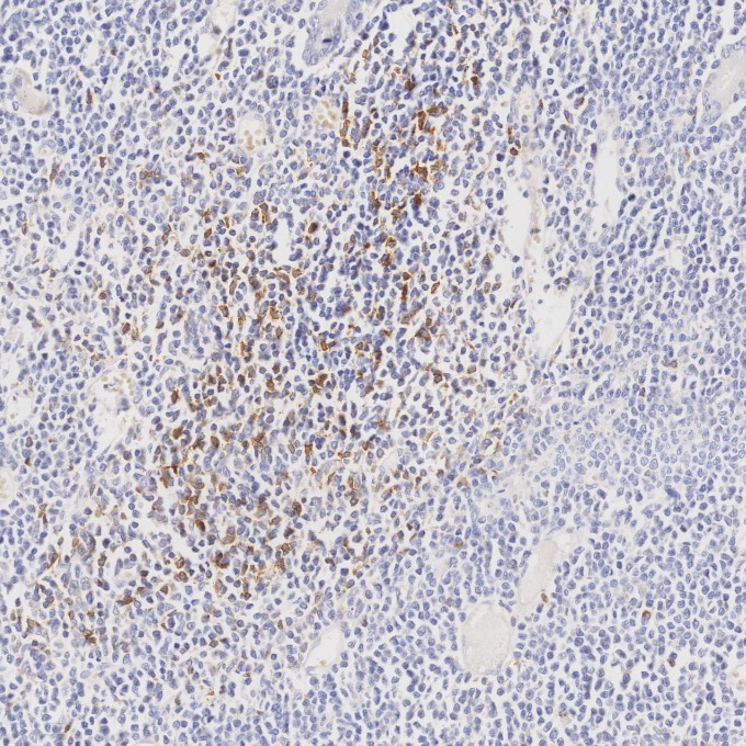 IHC staining of human lymphoma using 98068-1-RR (same clone as 98068-1-PBS) IHC staining of human lymphoma using 98068-1-RR (same clone as 98068-1-PBS)