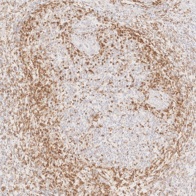 IHC staining of human lymphoma using 98068-1-RR (same clone as 98068-1-PBS) IHC staining of human lymphoma using 98068-1-RR (same clone as 98068-1-PBS)