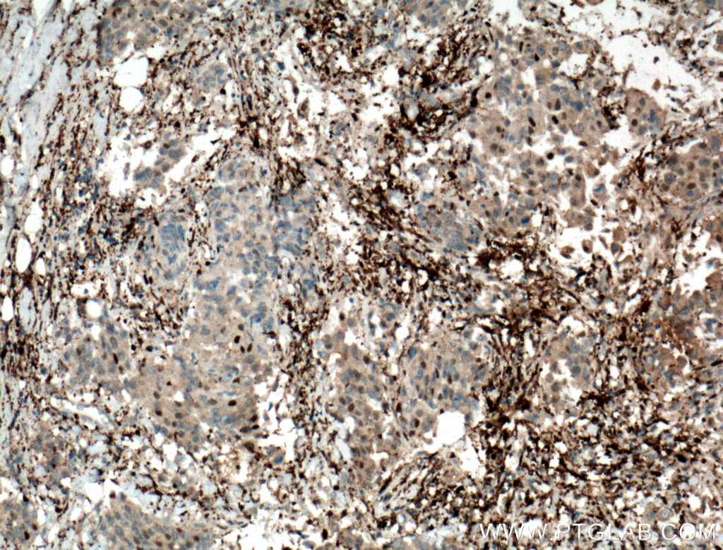 IHC staining of human breast cancer using 12383-1-AP