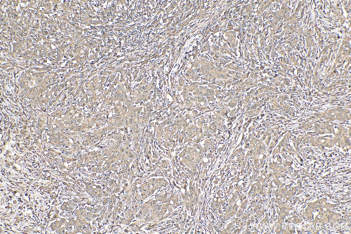 IHC staining of human stomach cancer using 12383-1-AP
