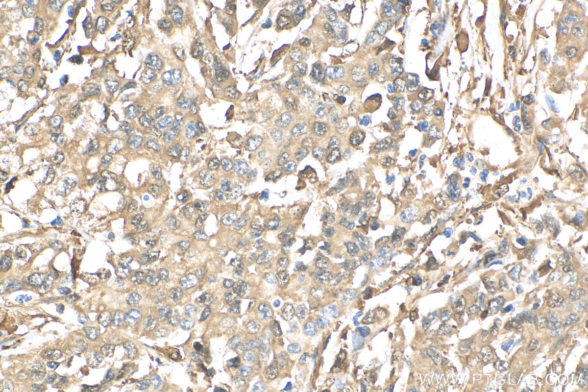 IHC staining of human stomach cancer using 12383-1-AP