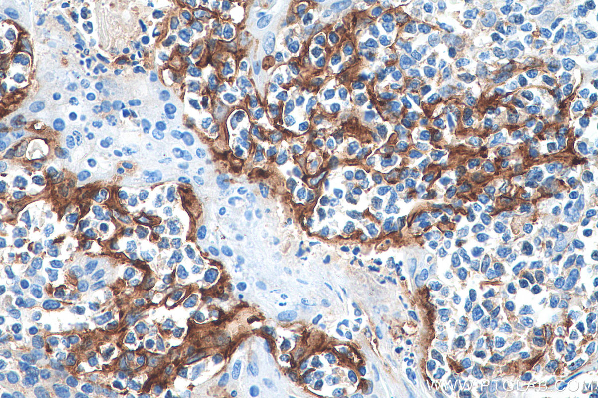 IHC staining of human tonsillitis using 28076-1-AP