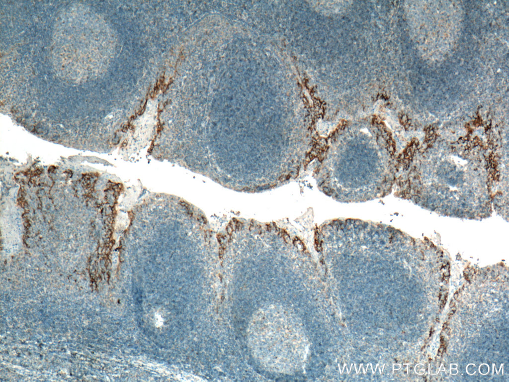 IHC staining of human tonsillitis using 66248-1-Ig (same clone as 66248-1-PBS)
