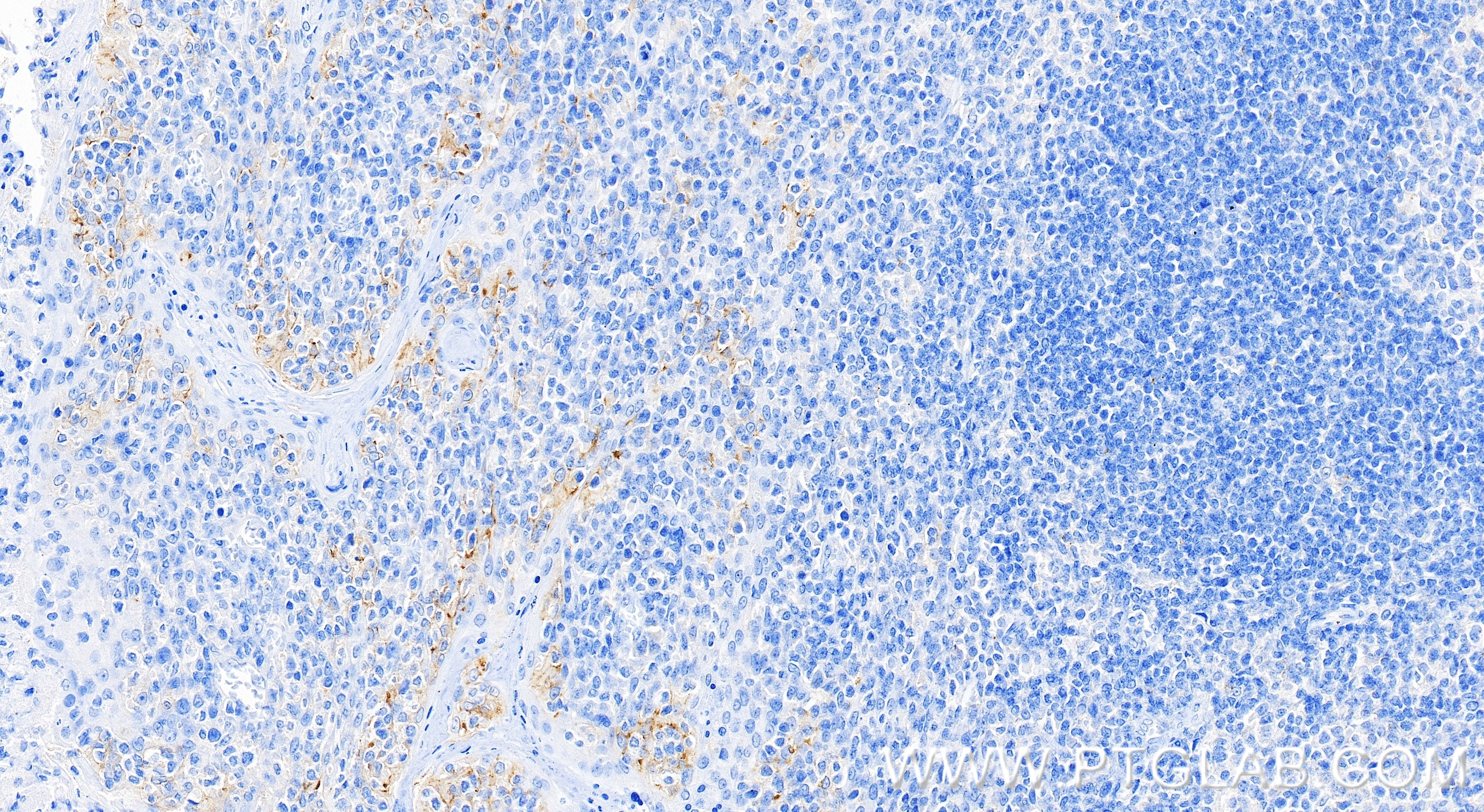 IHC staining of human tonsillitis using 83600-2-RR (same clone as 83600-2-PBS)