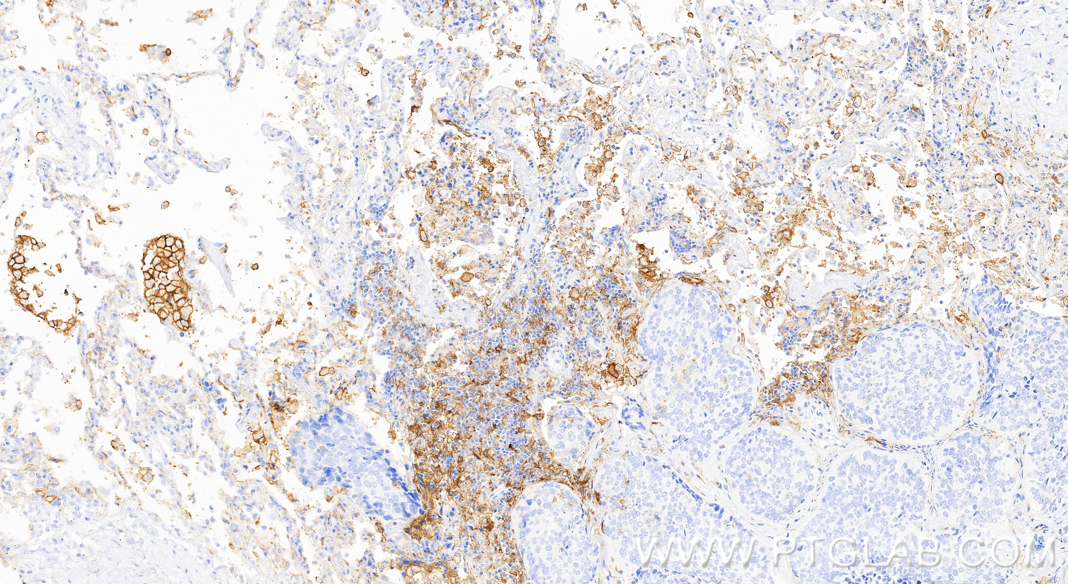 IHC staining of human lung cancer using 85229-23-RR