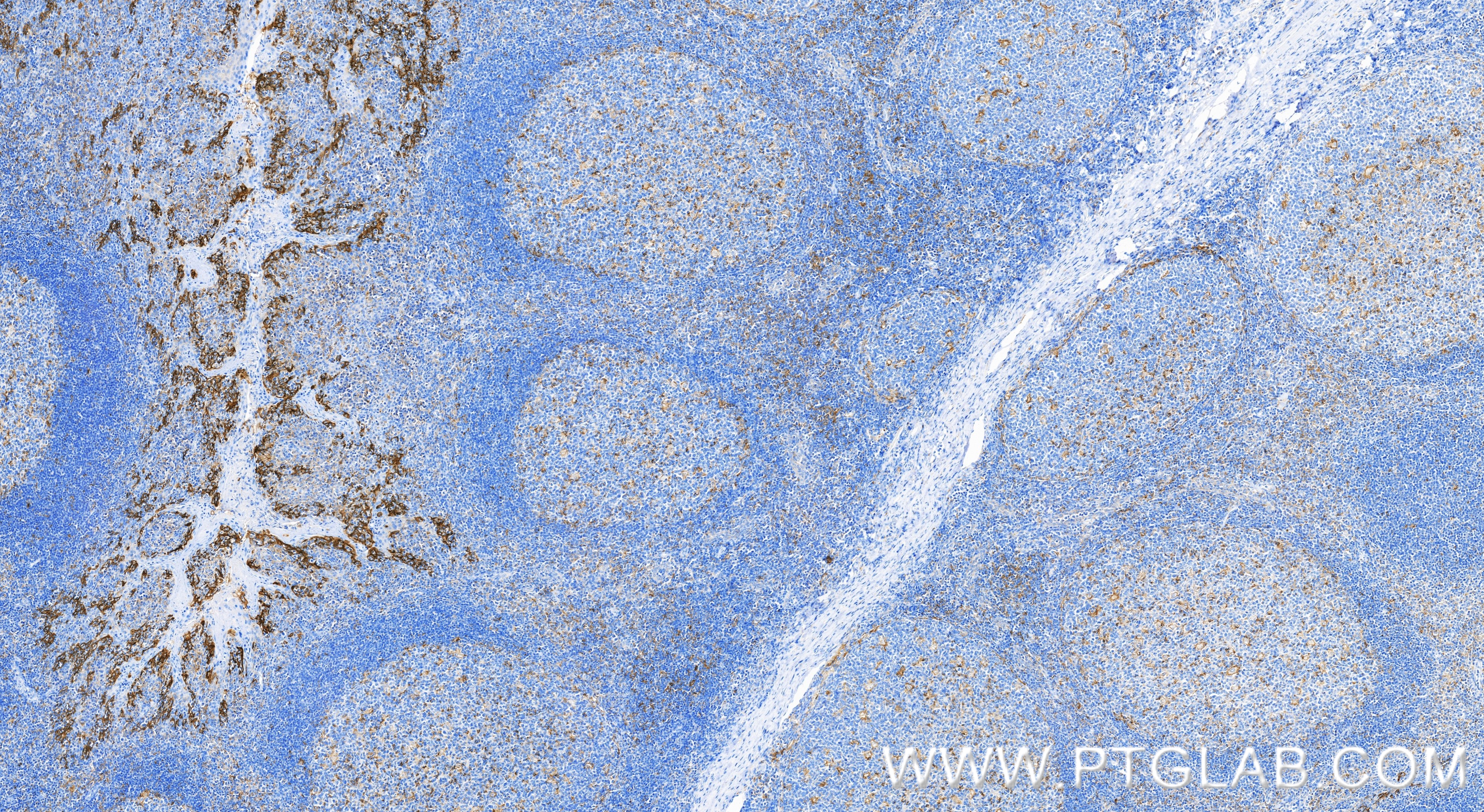 IHC staining of human tonsillitis using 85229-23-RR