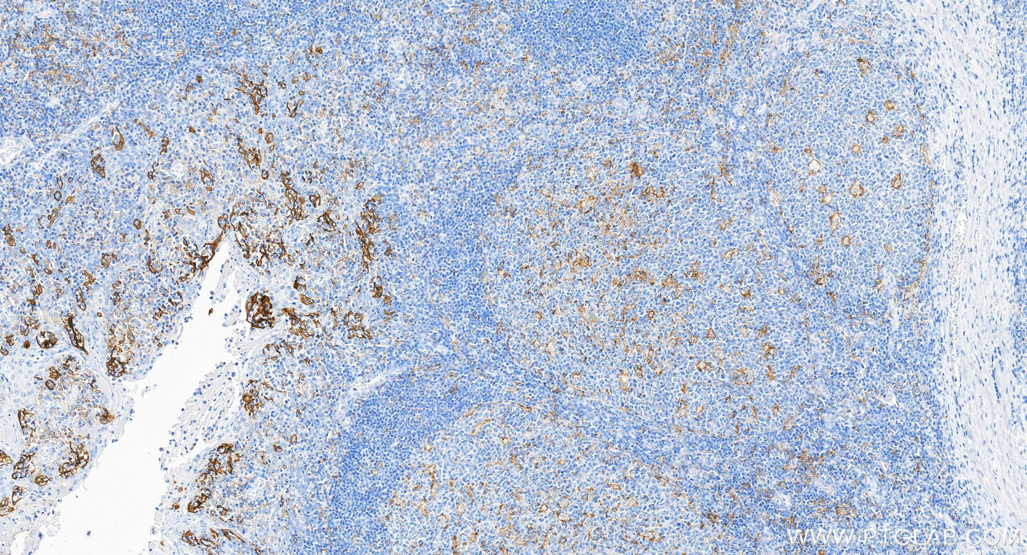 IHC staining of human tonsillitis using 85229-23-RR IHC staining of human tonsillitis using 85229-23-RR