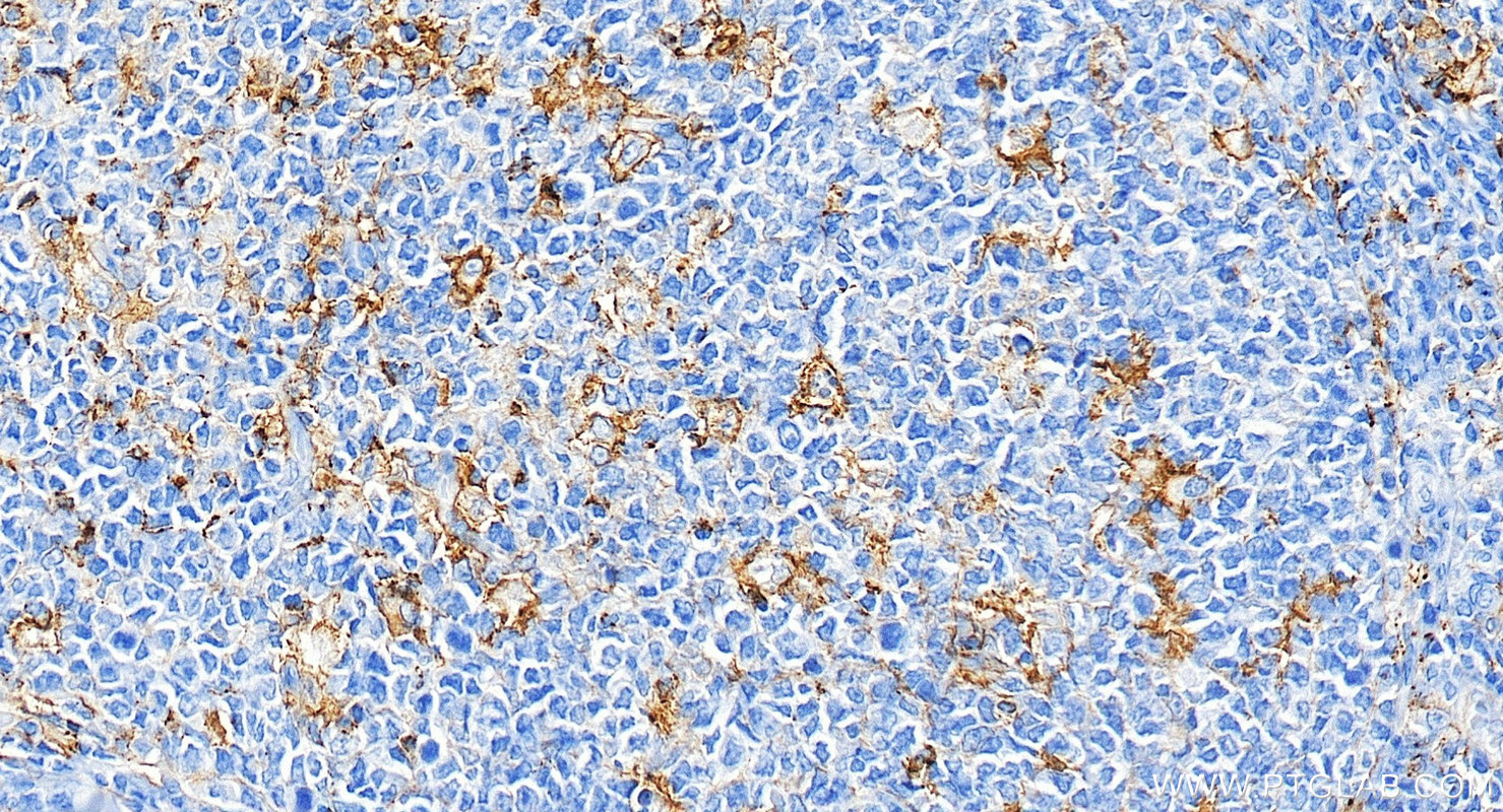 IHC staining of human tonsillitis using 85229-23-RR IHC staining of human tonsillitis using 85229-23-RR