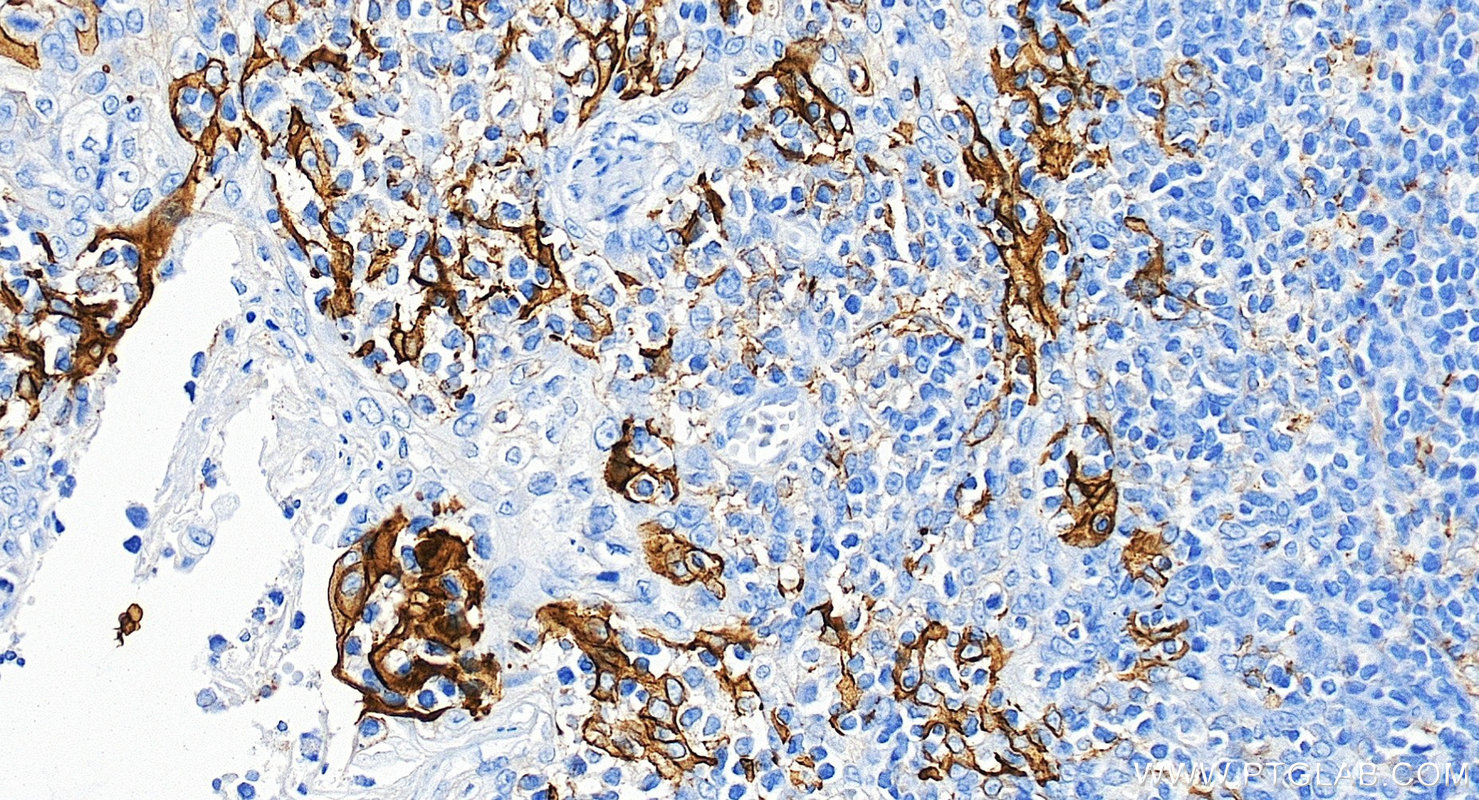 IHC staining of human tonsillitis using 85229-23-RR IHC staining of human tonsillitis using 85229-23-RR