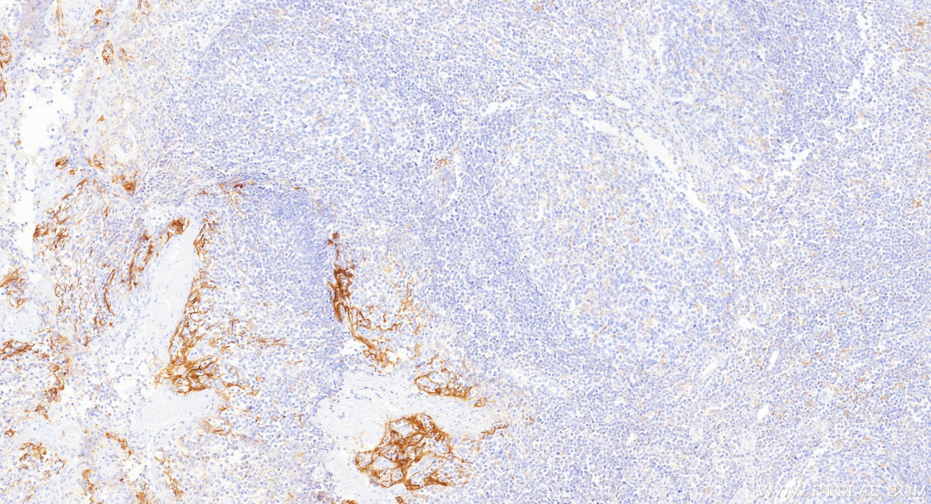 IHC staining of human tonsillitis using Biotin-85229-23
