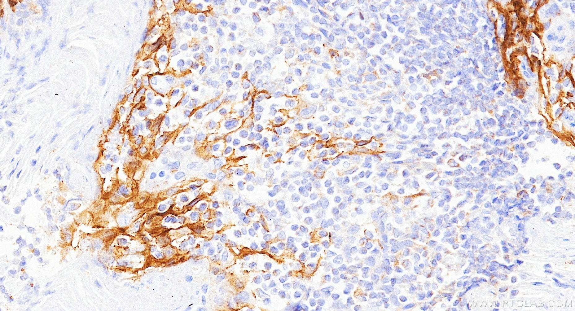 IHC staining of human tonsillitis using Biotin-85229-23
