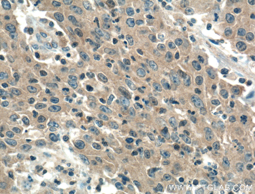 IHC staining of human colon cancer using 66440-1-Ig