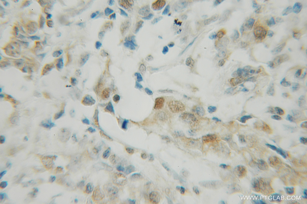 IHC staining of human breast cancer using 12587-1-AP