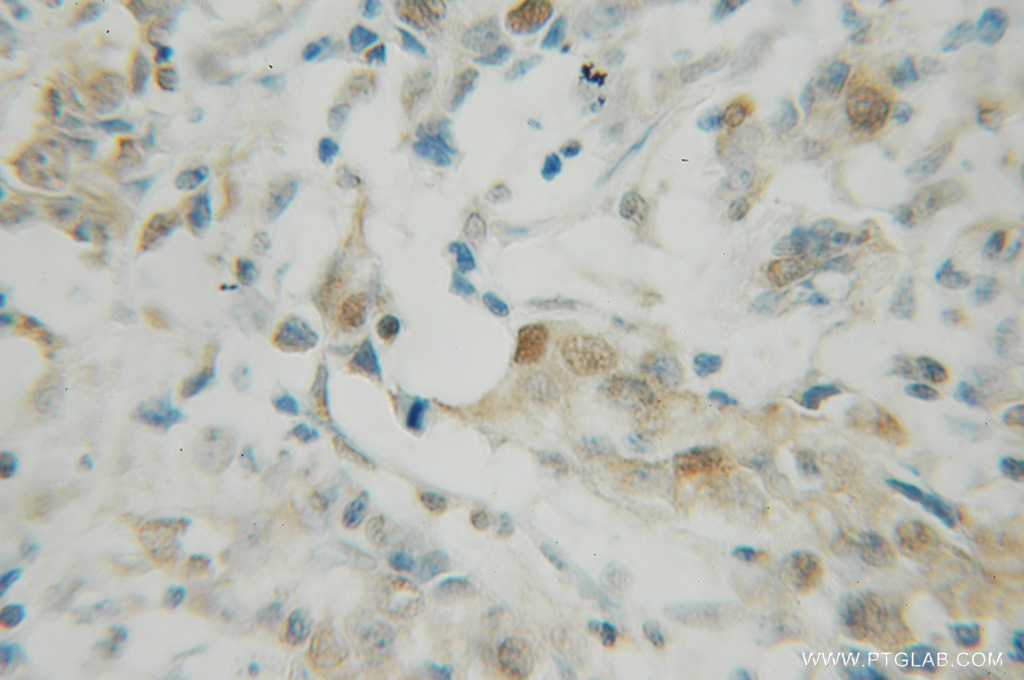 IHC staining of human breast cancer using 12587-1-AP (same clone as 12587-1-PBS)