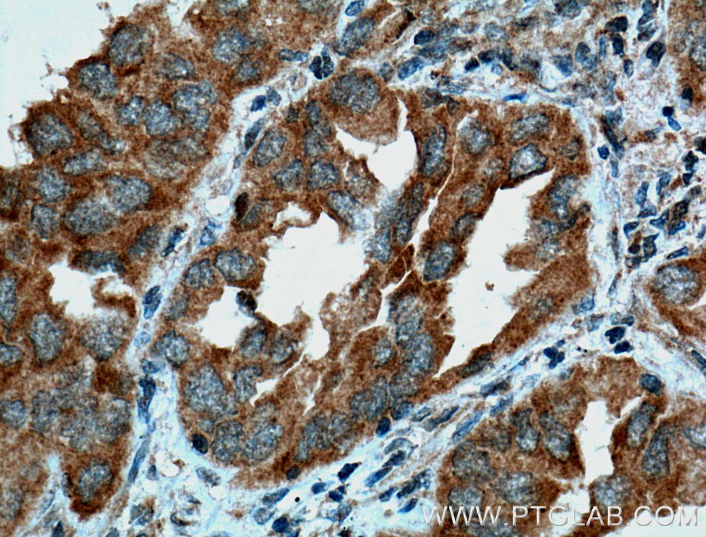 IHC staining of human lung cancer using 12303-1-AP