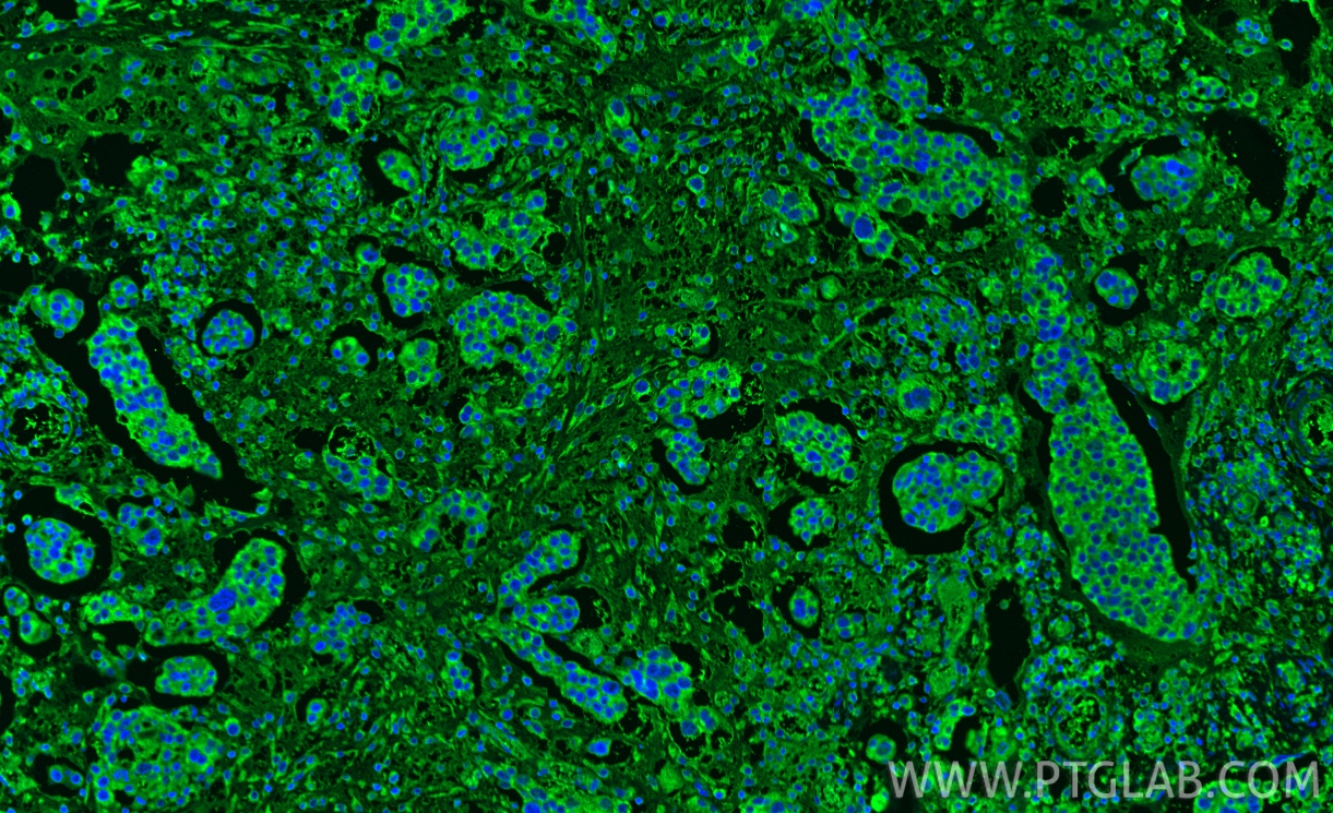 IF Staining of human ovary cancer using 24842-1-AP IF Staining of human ovary cancer using 24842-1-AP