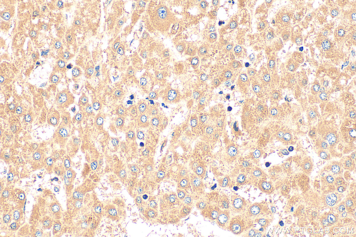 IHC staining of human liver cancer using 24842-1-AP