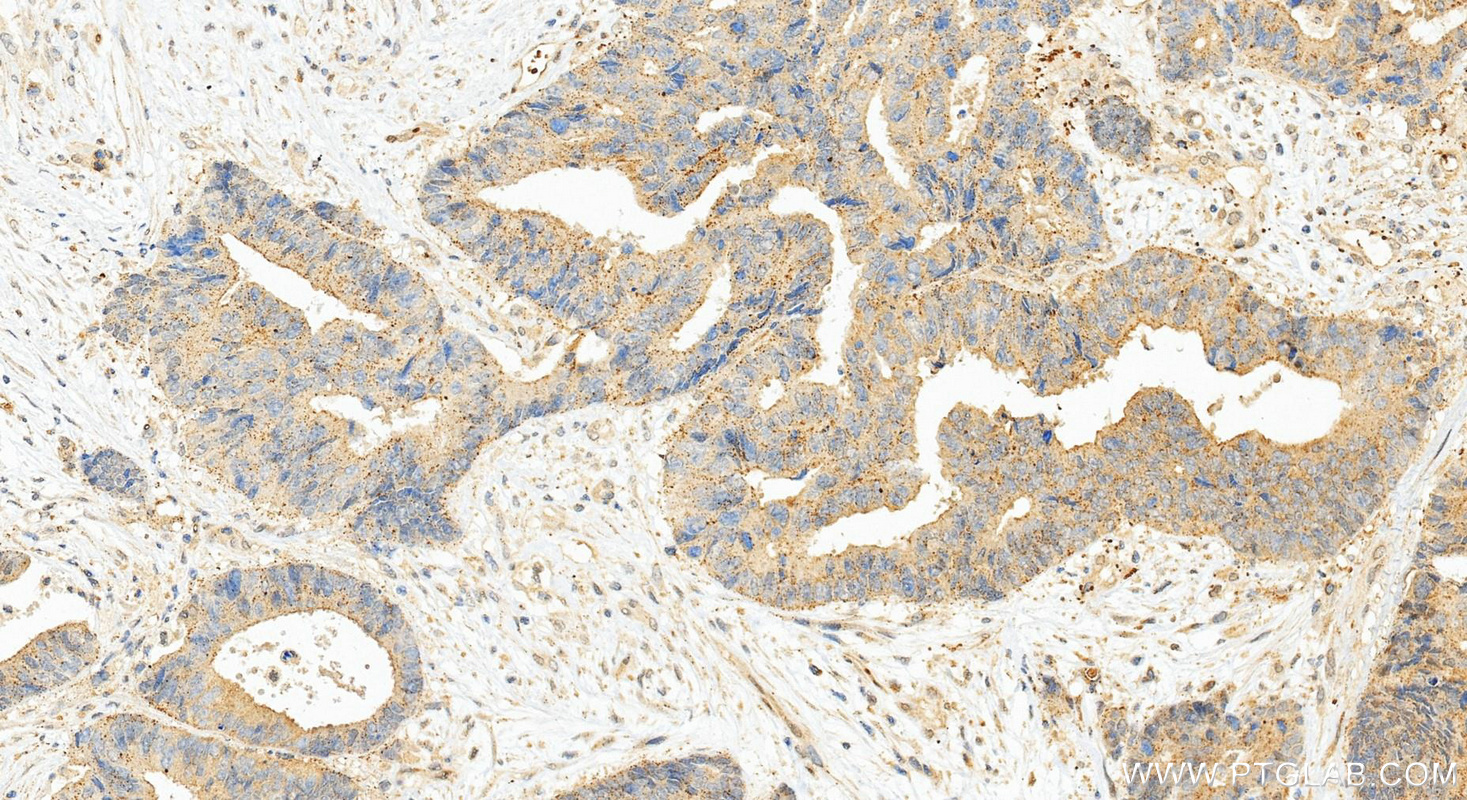 Immunohistochemical analysis of paraffin-embedded human colon cancer tissue slide using 14075-1-AP (PDGF-D antibody) at dilution of 1:1000 (under 20x lens). Heat mediated antigen retrieval with Tris-EDTA buffer (pH 9.0). IHC staining of human colon cancer using 14075-1-AP