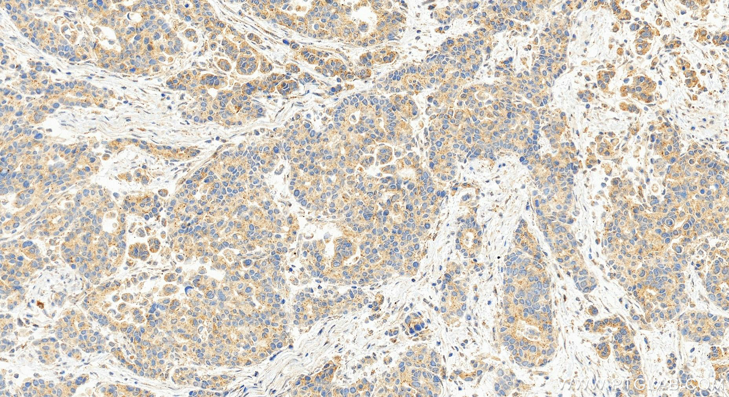 Immunohistochemical analysis of paraffin-embedded human stomach cancer tissue slide using 14075-1-AP (PDGF-D antibody) at dilution of 1:1000 (under 20x lens). Heat mediated antigen retrieval with Tris-EDTA buffer (pH 9.0). IHC staining of human stomach cancer using 14075-1-AP