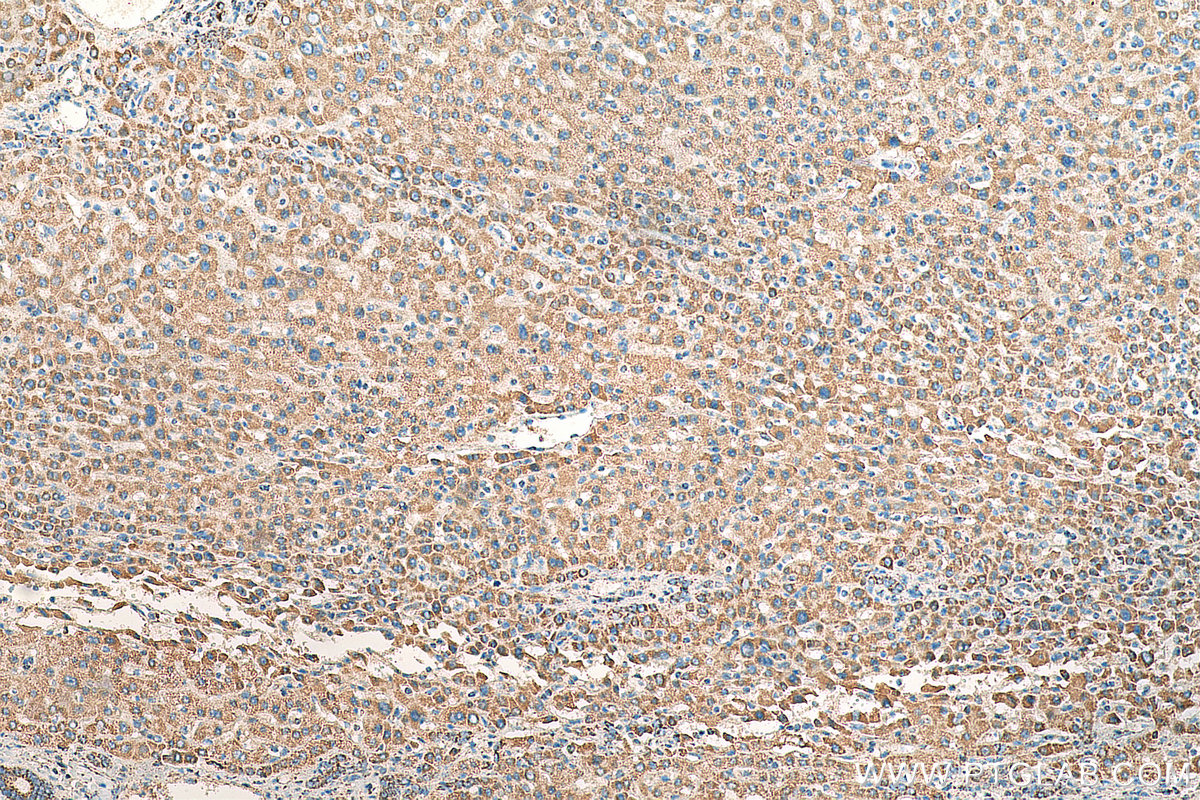 IHC staining of human liver cancer using 18068-1-AP