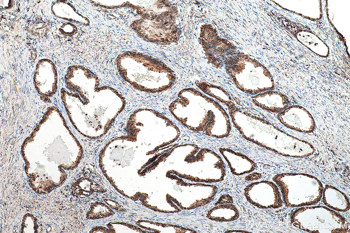 IHC staining of human prostate cancer using 80170-1-RR