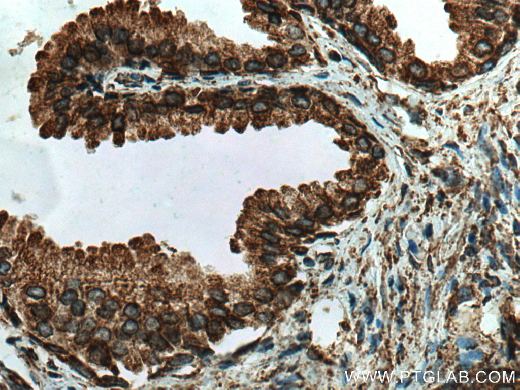 IHC staining of human prostate cancer using 11245-1-AP