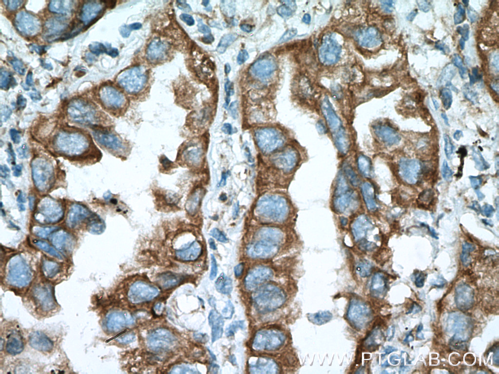 IHC staining of human lung cancer using 15967-1-AP