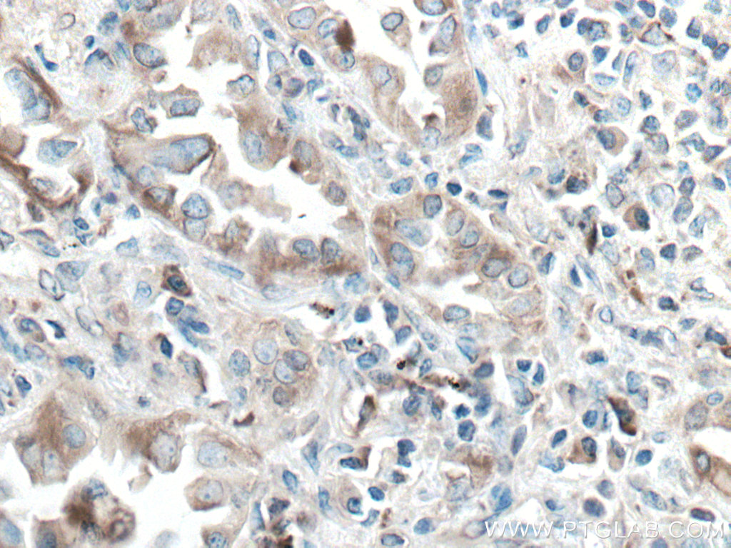 IHC staining of human lung cancer using 66423-1-Ig