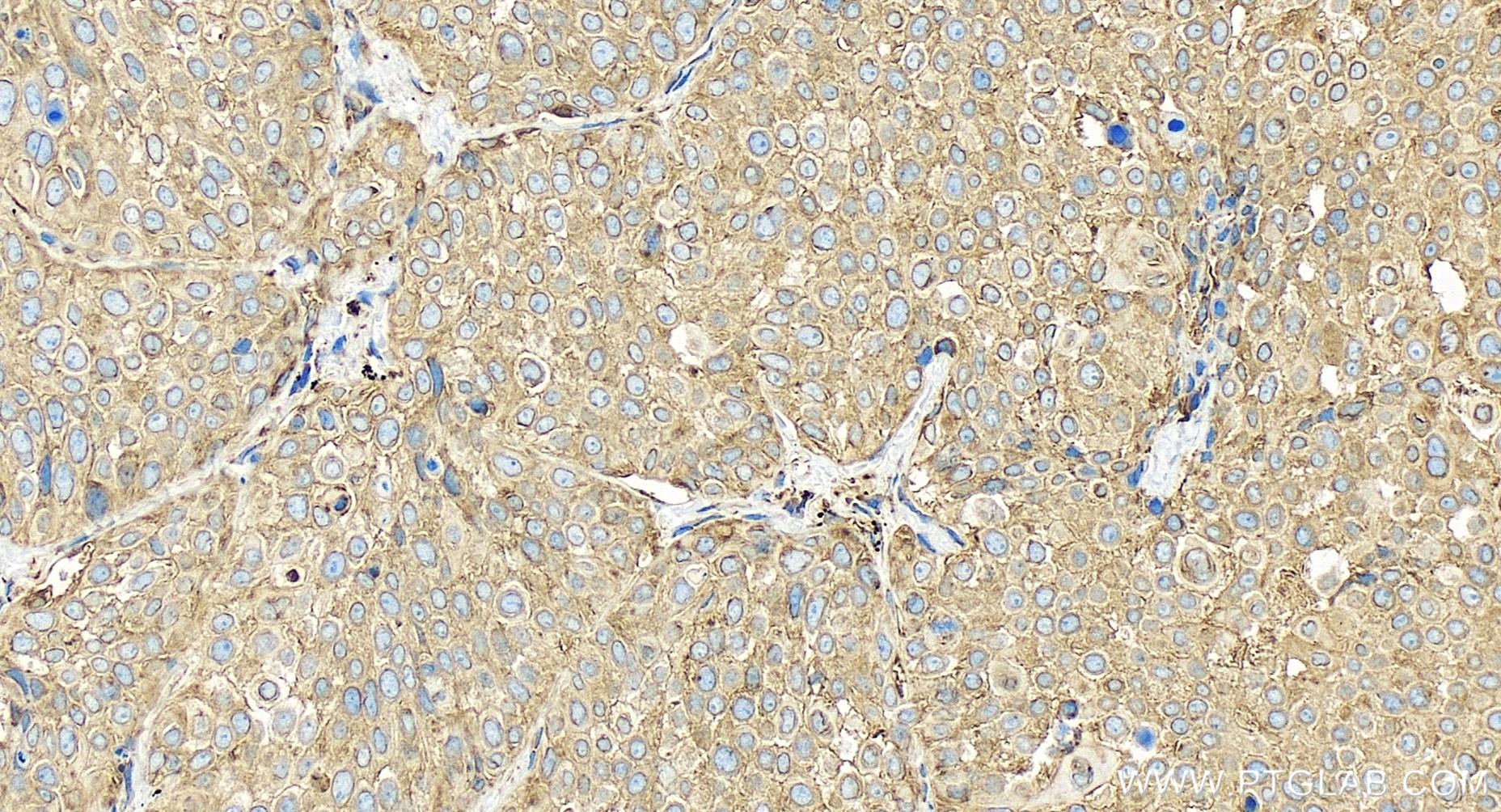 IHC staining of human lung cancer using 85087-5-RR (same clone as 85087-5-PBS)