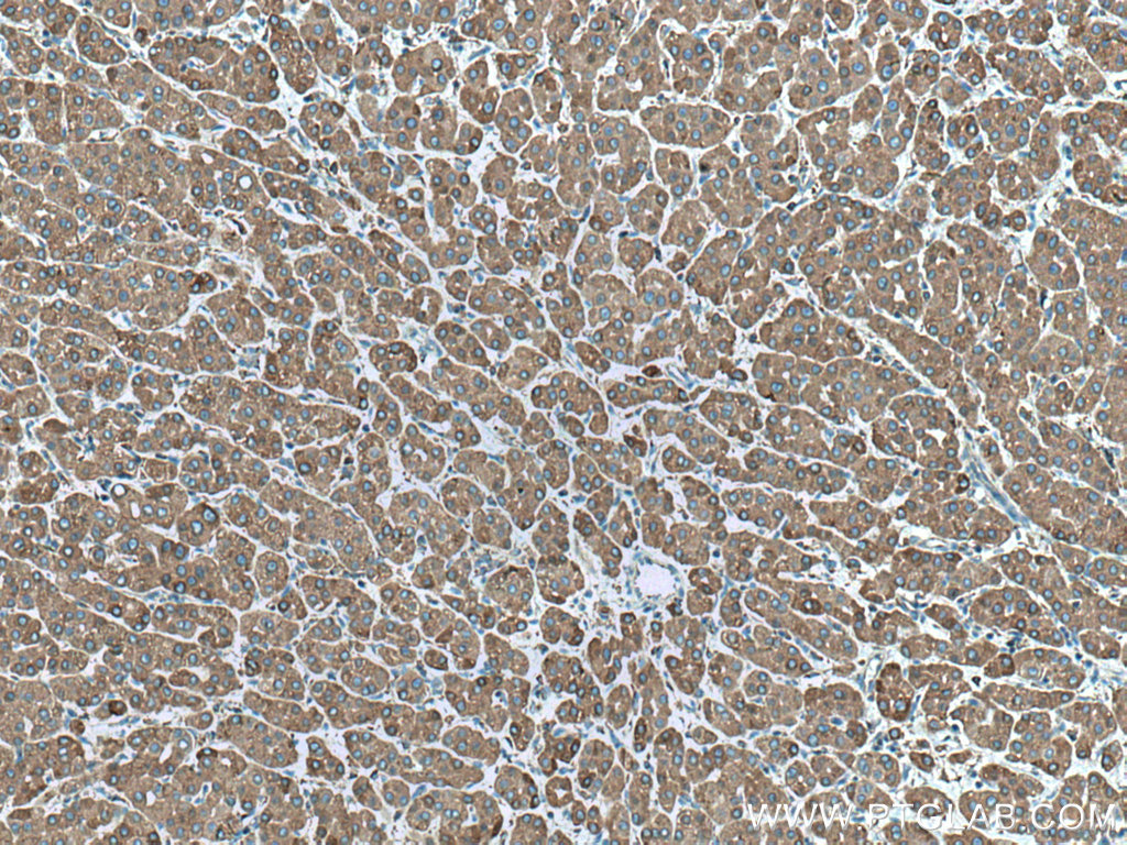 IHC staining of human liver cancer using 14712-1-AP