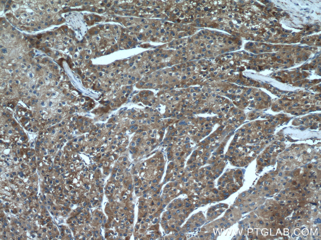 IHC staining of human liver cancer using 66669-1-Ig (same clone as 66669-1-PBS)