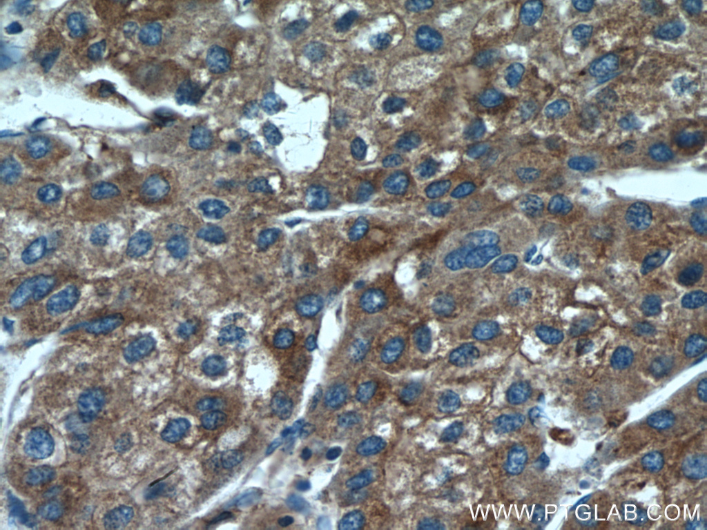 IHC staining of human liver cancer using 66669-1-Ig (same clone as 66669-1-PBS)