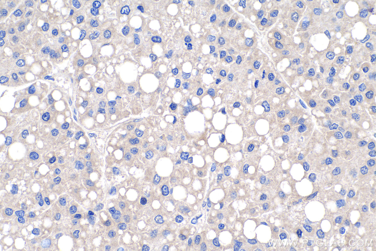 IHC staining of human liver cancer using 18262-1-AP