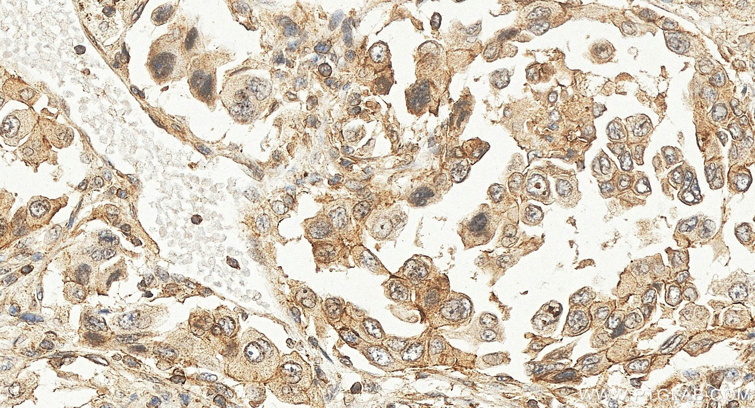 IHC staining of human lung cancer using 11574-1-AP IHC staining of human lung cancer using 11574-1-AP