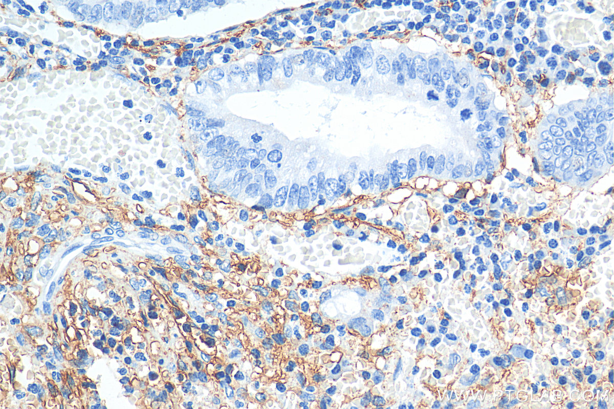 IHC staining of human appendicitis using 22099-1-AP