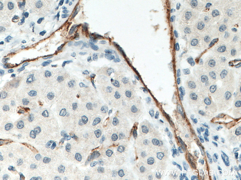 IHC staining of human liver cancer using 66065-1-Ig